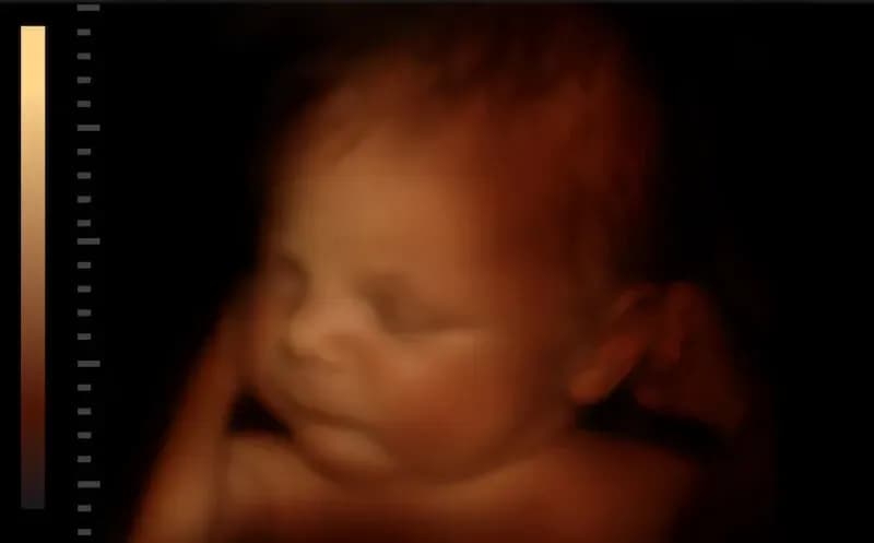 Polish woman tries to justify abortion at 37 weeks due to baby's disability