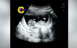 Thumbnail for Viral video of unborn baby moving while mother laughs reminds us that abortion is murder